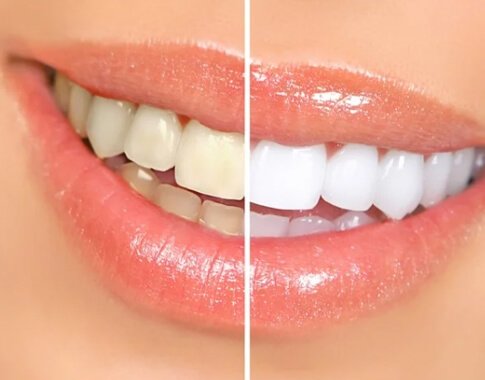 teeth whitening in dubai