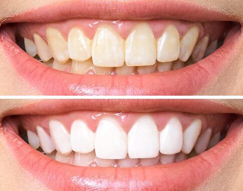 teeth whitening in dubai