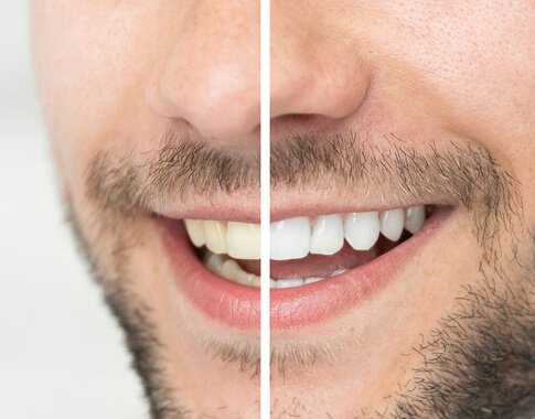 teeth whitening in dubai