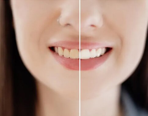 teeth whitening in dubai