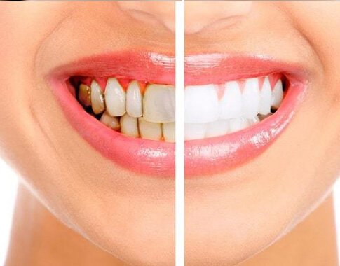 teeth whitening in dubai