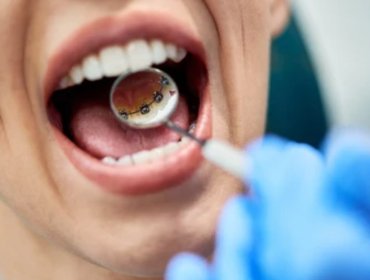 dental braces treatment in dubai