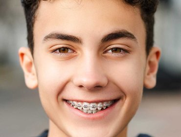 dental braces treatment in dubai